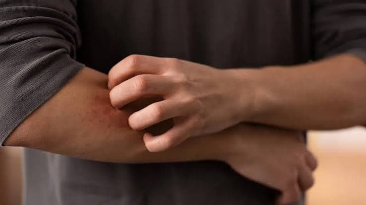 Dermatofilosi in aumento in Europa: Pregliasco rassicura sul rischio, ma avverte sui cambiamenti nei contagi